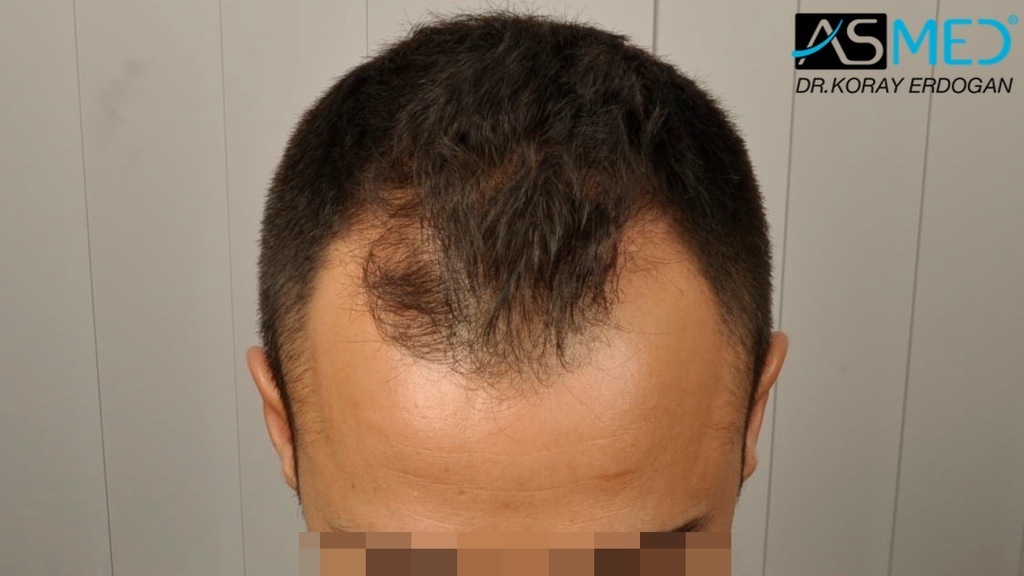 NORWOOD2 2400-grafts-FUE file_zpsfb9a8285
