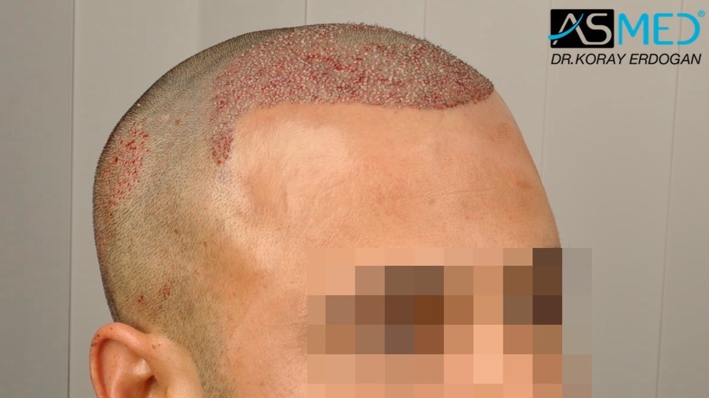 NORWOOD2 2400-grafts-FUE file_zpsfd431a39