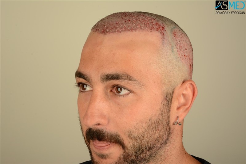 NORWOOD2 2803-grafts-FUE 3