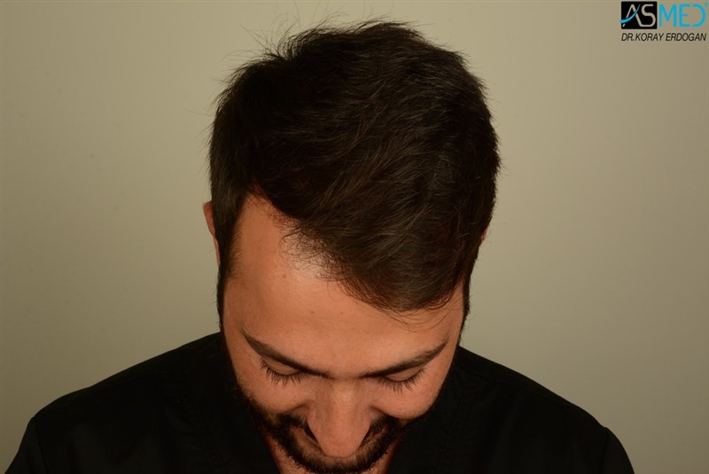 NORWOOD2 2803-grafts-FUE V2_DSC_8519aaa_zps0m1rteib