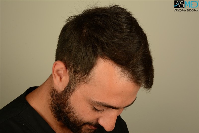 NORWOOD2 2803-grafts-FUE V2_DSC_8521aaa_zpspnynlcba