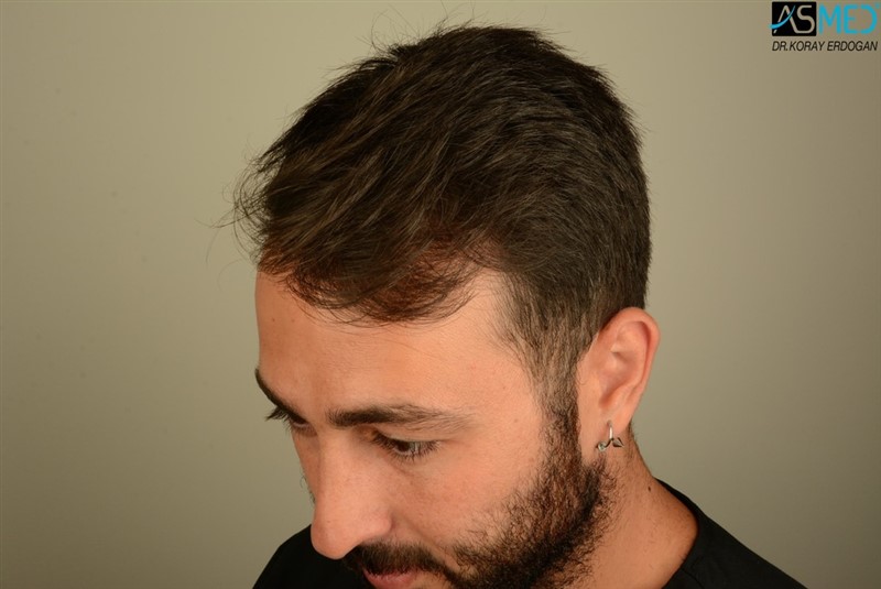 NORWOOD2 2803-grafts-FUE V2_DSC_8523aaa_zpssozkfgmf