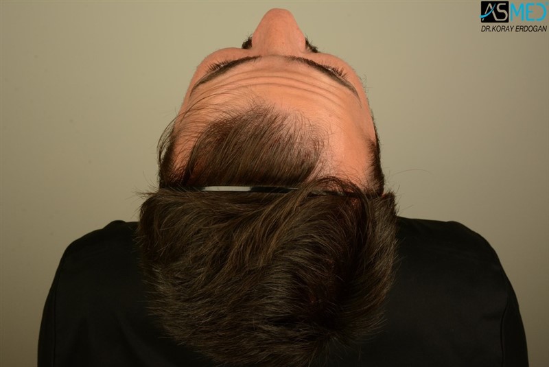 NORWOOD2 2803-grafts-FUE V2_DSC_8535aaa_zpse3vzglke