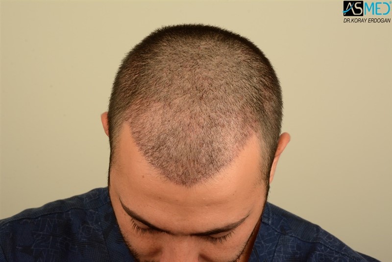 NORWOOD2 2803-grafts-FUE V2_DSC_9501aaa_zpspxubewdo