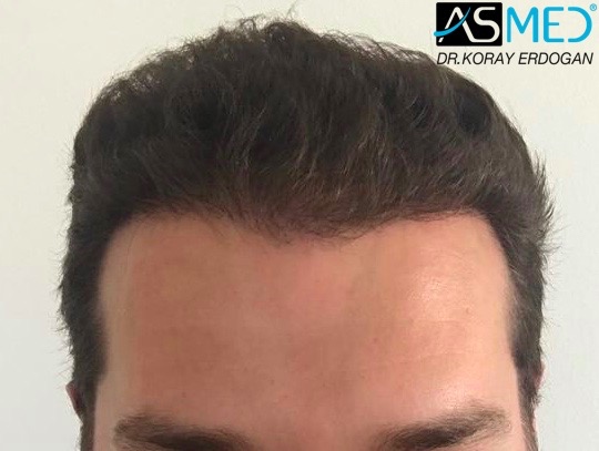 https://www.hairtransplantfue.org/asmed-hair-transplant-result/upload/NORWOOD2/2808-grafts-FUE/5months/1.jpg