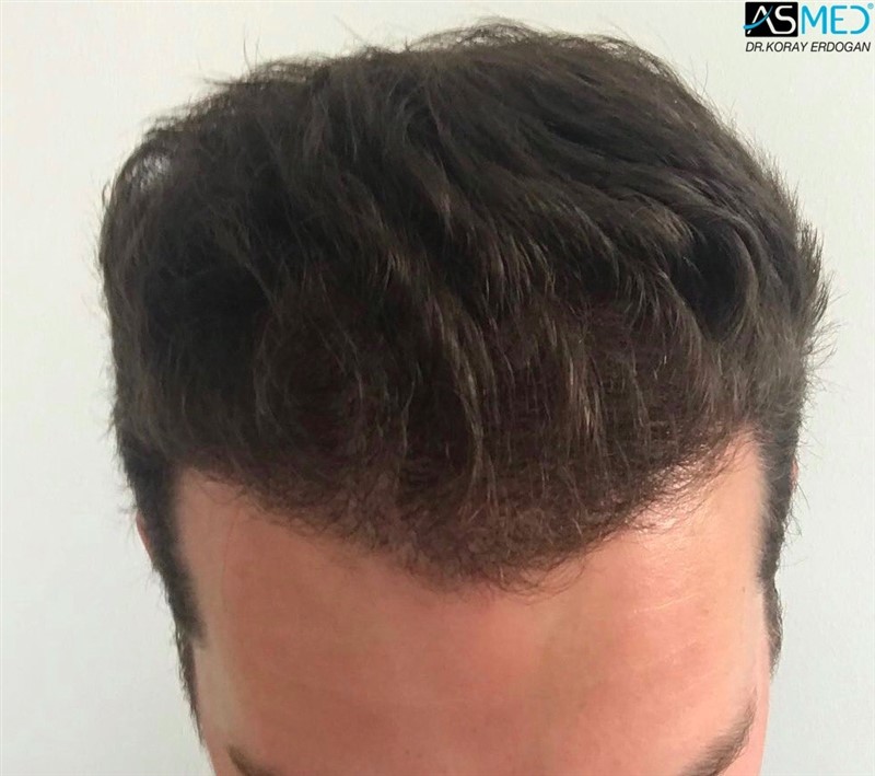 https://www.hairtransplantfue.org/asmed-hair-transplant-result/upload/NORWOOD2/2808-grafts-FUE/5months/2.jpg