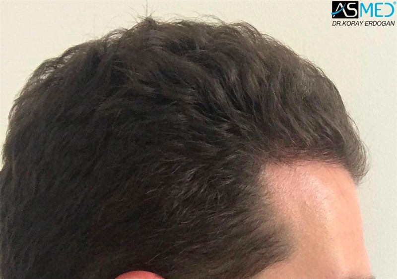 https://www.hairtransplantfue.org/asmed-hair-transplant-result/upload/NORWOOD2/2808-grafts-FUE/5months/3.jpg