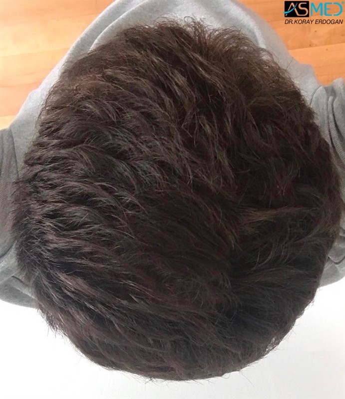 https://www.hairtransplantfue.org/asmed-hair-transplant-result/upload/NORWOOD2/2808-grafts-FUE/5months/5.jpg