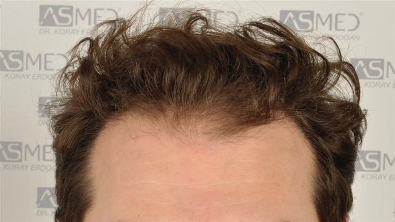 https://www.hairtransplantfue.org/asmed-hair-transplant-result/upload/NORWOOD2/2808-grafts-FUE/before/_DSC4813.jpg