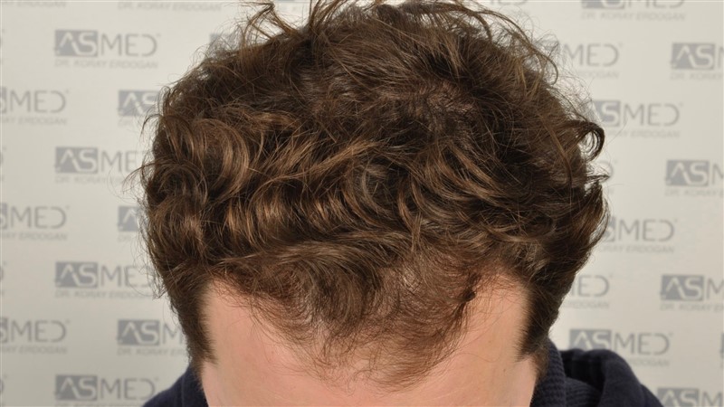 https://www.hairtransplantfue.org/asmed-hair-transplant-result/upload/NORWOOD2/2808-grafts-FUE/before/_DSC4814.jpg