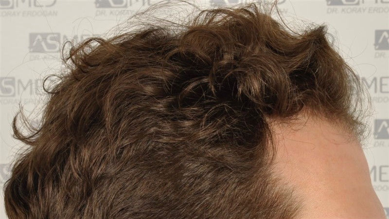 https://www.hairtransplantfue.org/asmed-hair-transplant-result/upload/NORWOOD2/2808-grafts-FUE/before/_DSC4820.jpg