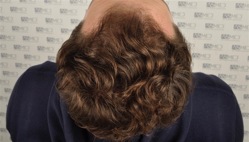 https://www.hairtransplantfue.org/asmed-hair-transplant-result/upload/NORWOOD2/2808-grafts-FUE/before/_DSC4822.jpg