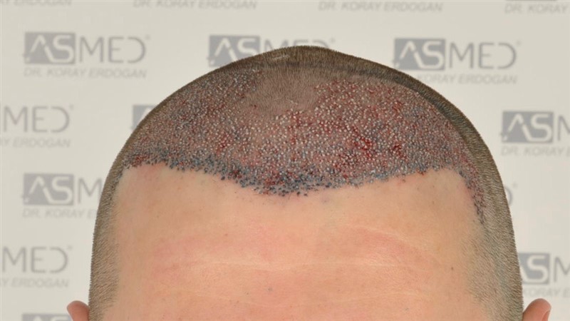 https://www.hairtransplantfue.org/asmed-hair-transplant-result/upload/NORWOOD2/2808-grafts-FUE/operation/_DSC4957.jpg