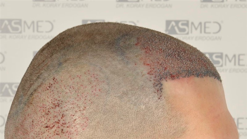 https://www.hairtransplantfue.org/asmed-hair-transplant-result/upload/NORWOOD2/2808-grafts-FUE/operation/_DSC4964.jpg