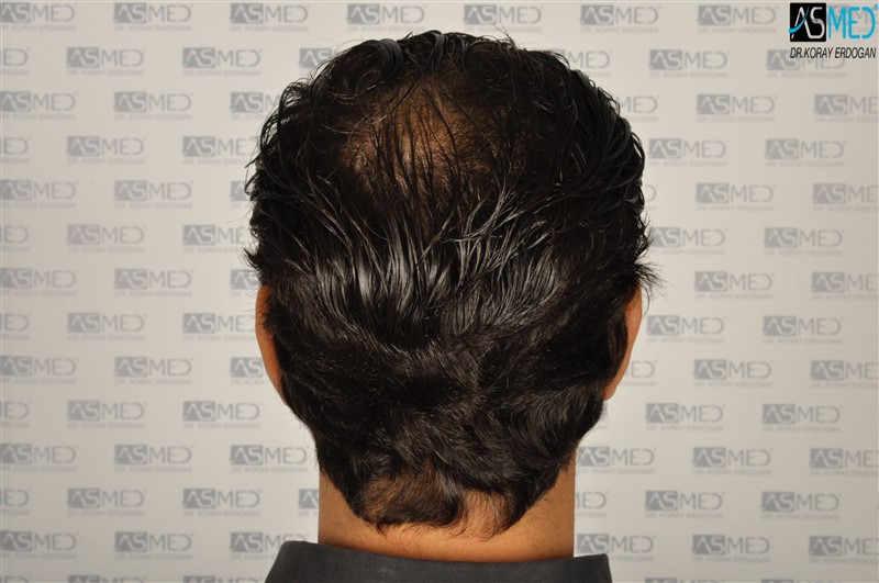 NORWOOD2 3012-grafts-FUE after2years6months V2__DSC6013aaa