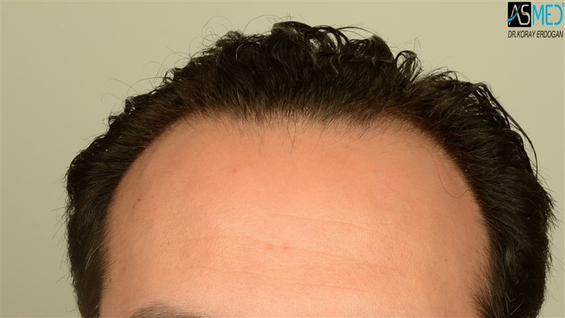 NORWOOD2 3012-grafts-FUE beforeoperation V2_DSC_4801aaa