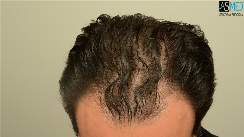NORWOOD2 3012-grafts-FUE beforeoperation V2_DSC_4802aaa