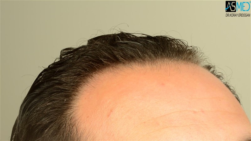 NORWOOD2 3012-grafts-FUE beforeoperation V2_DSC_4803aaa