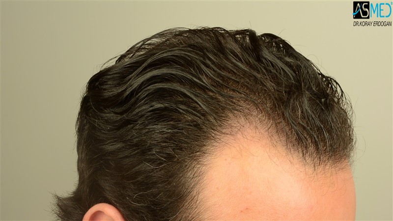 NORWOOD2 3012-grafts-FUE beforeoperation V2_DSC_4804aaa