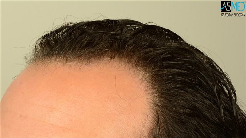 NORWOOD2 3012-grafts-FUE beforeoperation V2_DSC_4805aaa
