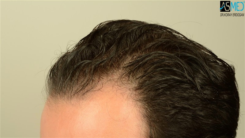 NORWOOD2 3012-grafts-FUE beforeoperation V2_DSC_4806aaa