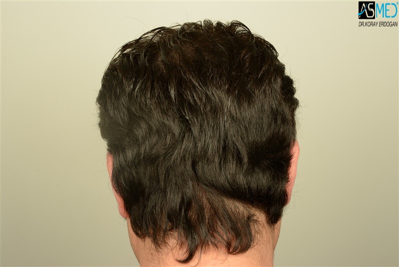 NORWOOD2 3012-grafts-FUE beforeoperation V2_DSC_4809aaa