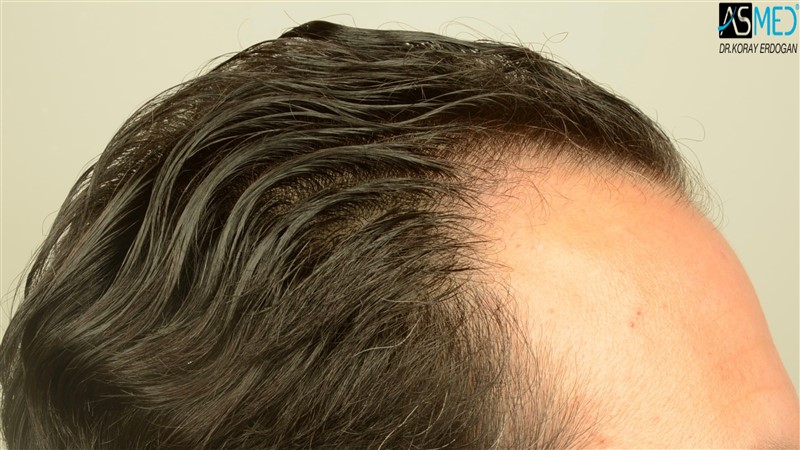 NORWOOD2 3012-grafts-FUE beforeoperation V2_DSC_4811aaa