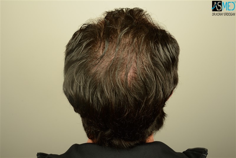 NORWOOD2 3012-grafts-FUE beforeoperation V2_DSC_4812aaa