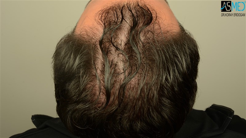 NORWOOD2 3012-grafts-FUE beforeoperation V2_DSC_4814aaa