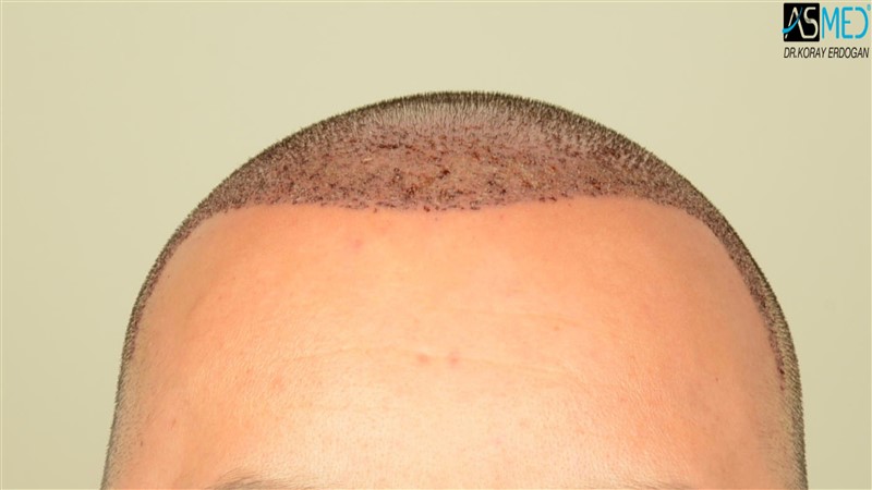 NORWOOD2 3012-grafts-FUE operation V2_DSC_5056aaa