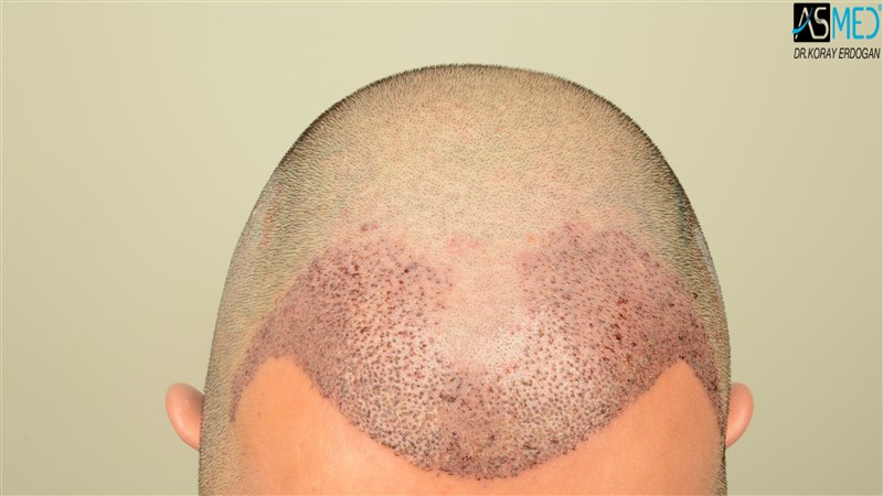 NORWOOD2 3012-grafts-FUE operation V2_DSC_5057aaa