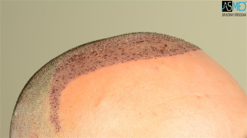 NORWOOD2 3012-grafts-FUE operation V2_DSC_5058aaa