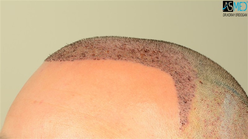 NORWOOD2 3012-grafts-FUE operation V2_DSC_5060aaa