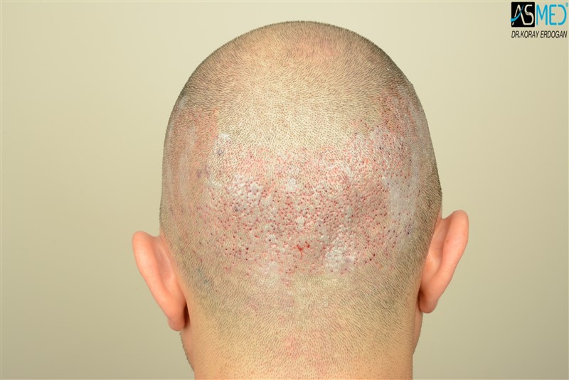 NORWOOD2 3012-grafts-FUE operation V2_DSC_5062aaa