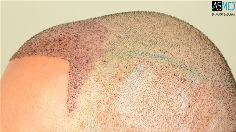 NORWOOD2 3012-grafts-FUE operation V2_DSC_5063aaa