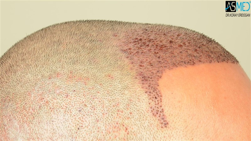 NORWOOD2 3012-grafts-FUE operation V2_DSC_5064aaa