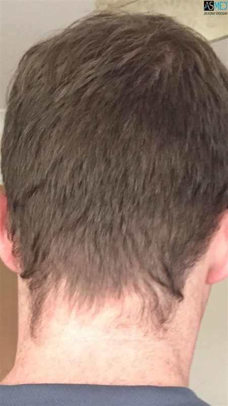NORWOOD2 3705-grafts-FUE 1year V2_6aaa