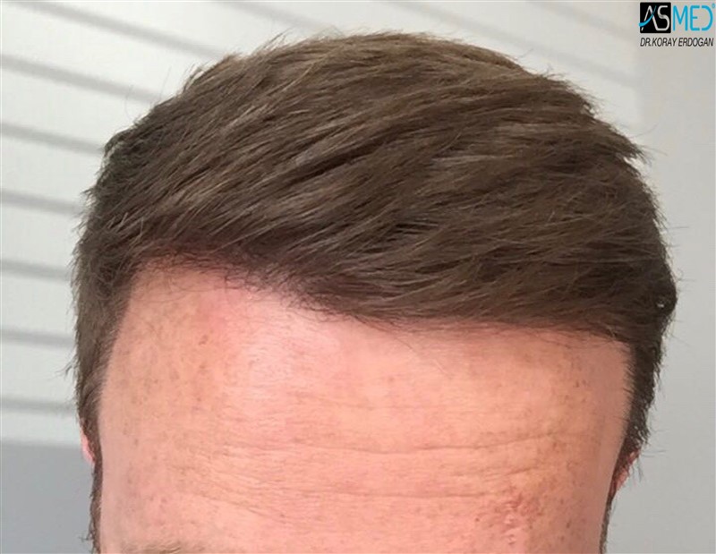 NORWOOD2 3705-grafts-FUE 1year5months V2_2017-05-08-PHOTO-00000056aaa