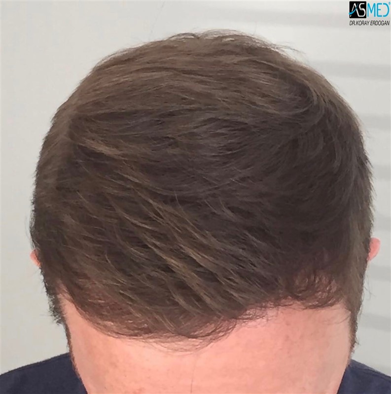 NORWOOD2 3705-grafts-FUE 1year5months V2_2017-05-08-PHOTO-00000057aaa