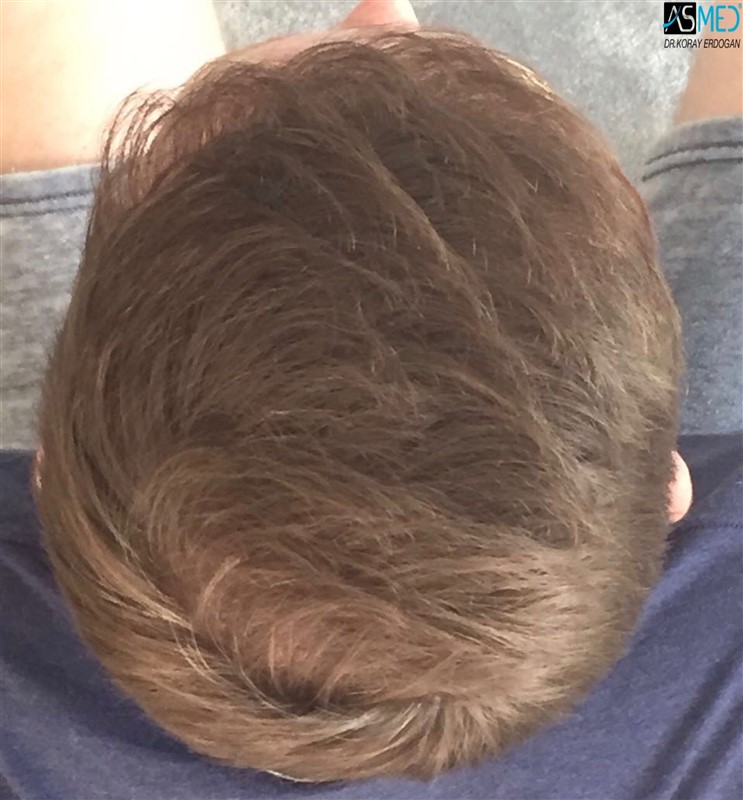 NORWOOD2 3705-grafts-FUE 1year5months V2_2017-05-08-PHOTO-00000058aaa
