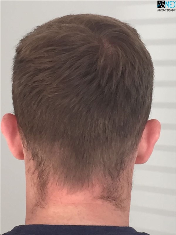NORWOOD2 3705-grafts-FUE 1year5months V2_2017-05-08-PHOTO-00000059aaa