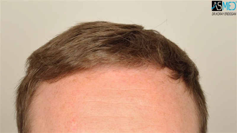 NORWOOD2 3705-grafts-FUE before V2__DSC9170aaa