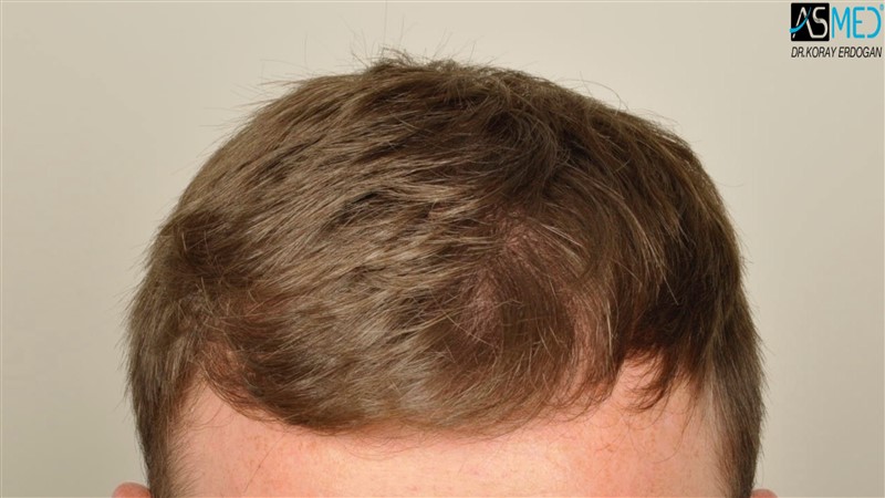 NORWOOD2 3705-grafts-FUE before V2__DSC9171aaa