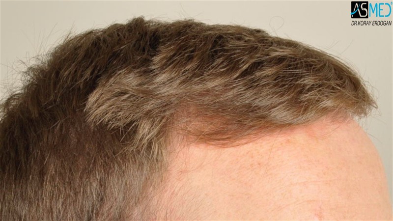 NORWOOD2 3705-grafts-FUE before V2__DSC9172aaa