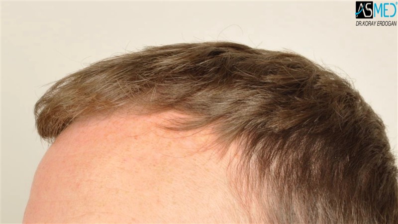 NORWOOD2 3705-grafts-FUE before V2__DSC9174aaa