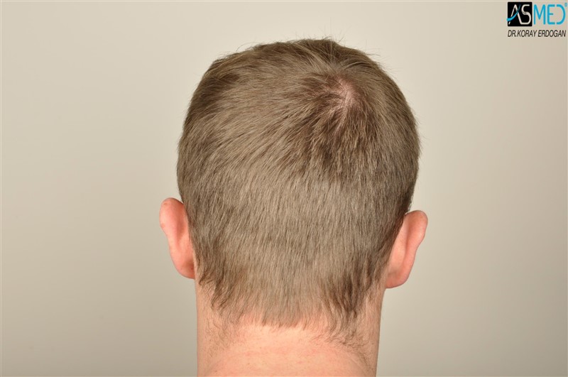 NORWOOD2 3705-grafts-FUE before V2__DSC9176aaa