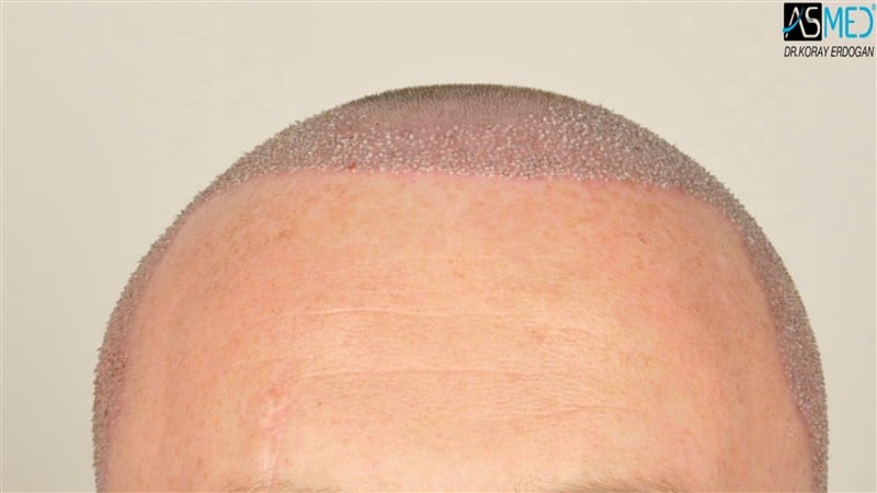 NORWOOD2 3705-grafts-FUE operation V2__DSC9379aaa