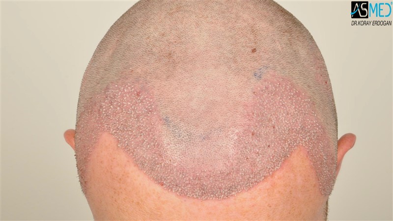 NORWOOD2 3705-grafts-FUE operation V2__DSC9380aaa
