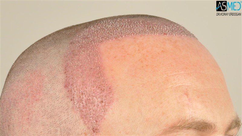 NORWOOD2 3705-grafts-FUE operation V2__DSC9381aaa