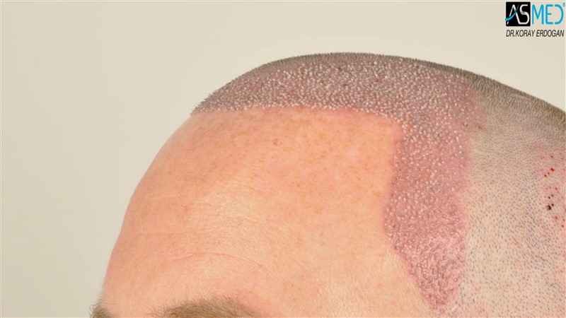 NORWOOD2 3705-grafts-FUE operation V2__DSC9383aaa